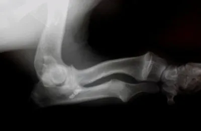 Частный случай развития привычного вывиха локтевого сустава при нарушении роста костей предплечья.